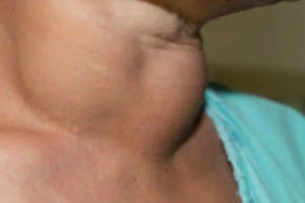 Thyroid Surgery